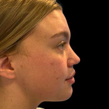 ultrasonic-rhinoplasty-before